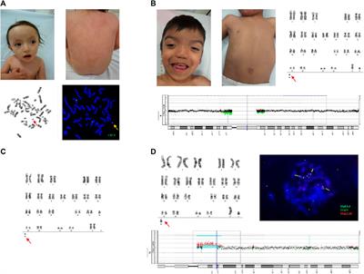 Cytogenomic characterization of small supernumerary marker chromosomes in patients with pigmentary mosaicism